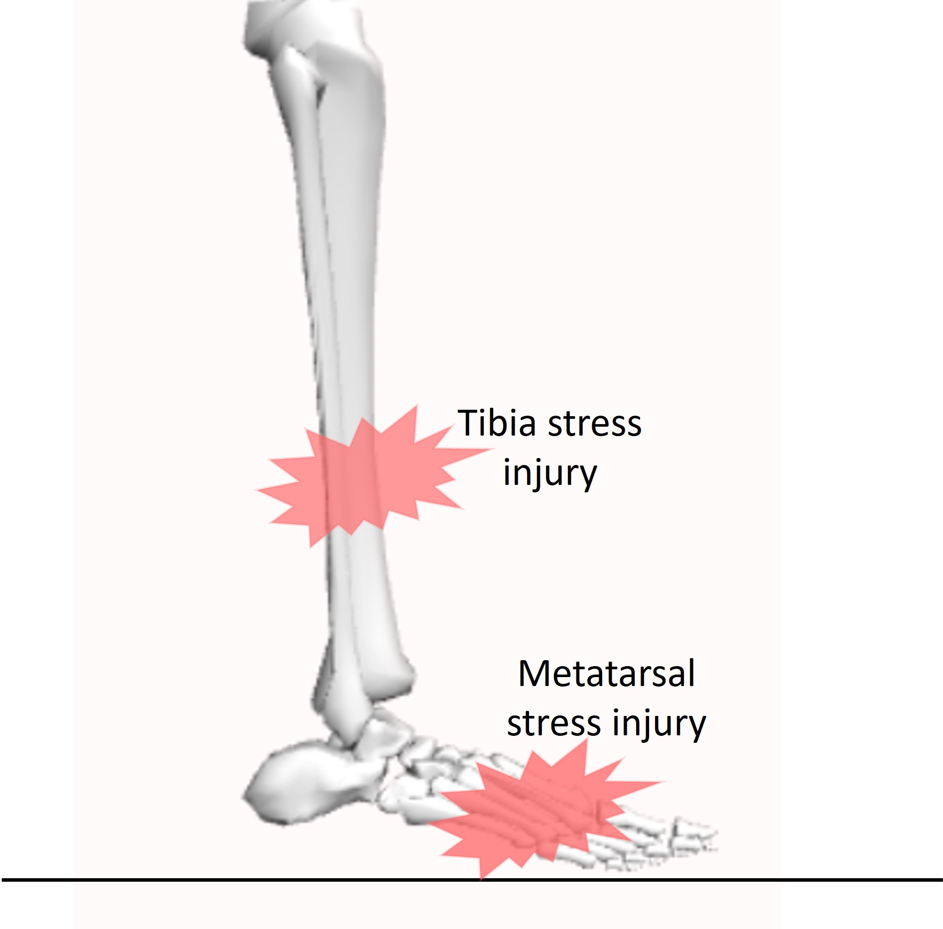 Bone stress injuries Bone stress injuries